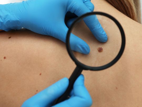 Znamiona barwnikowe – kiedy wymagają konsultacji dermatologa?