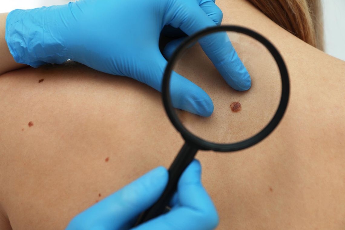 Znamiona barwnikowe – kiedy wymagają konsultacji dermatologa? Znamiona barwnikowe – kiedy wymagają konsultacji dermatologa?